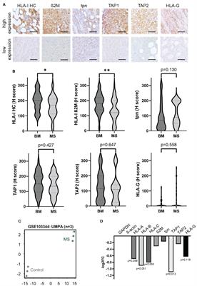 Association of immune evasion in myeloid sarcomas with disease manifestation and patients’ survival